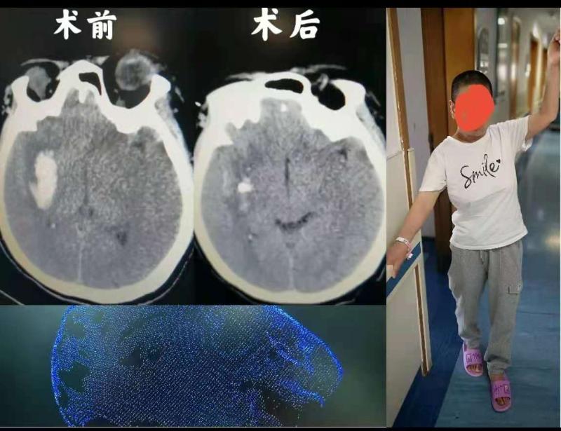 附属九院神经外科北部院区完成3D结构光机器人辅助脑出血清除手术