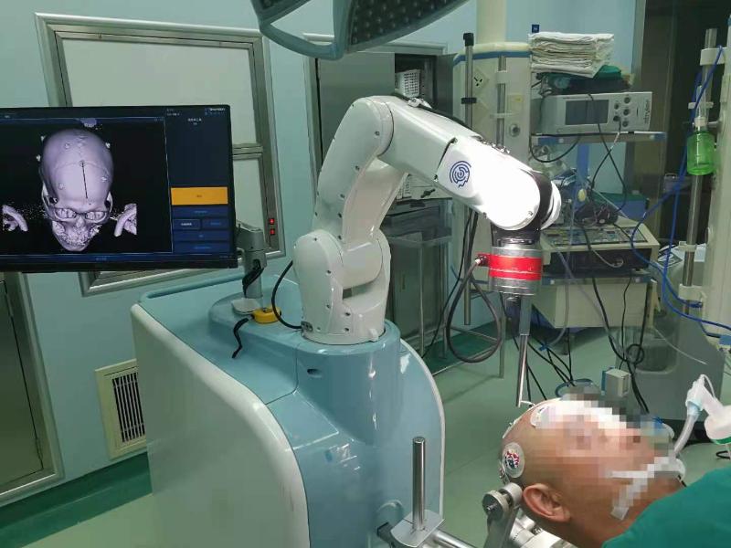 附属九院神经外科北部院区完成3D结构光机器人辅助脑出血清除手术