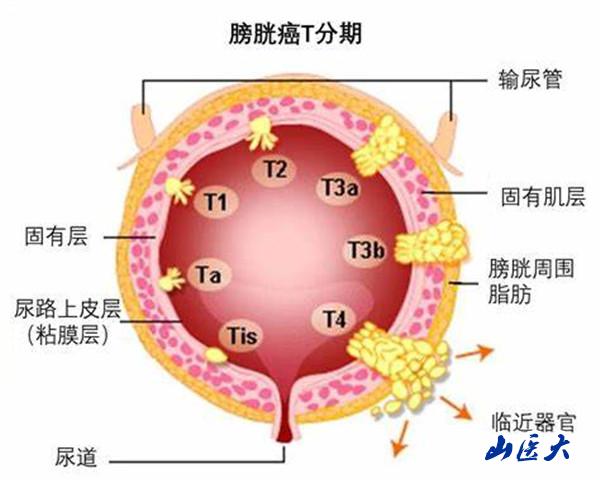 第一医院积极开展非肌层浸润膀胱肿瘤铥激光日间手术治疗
